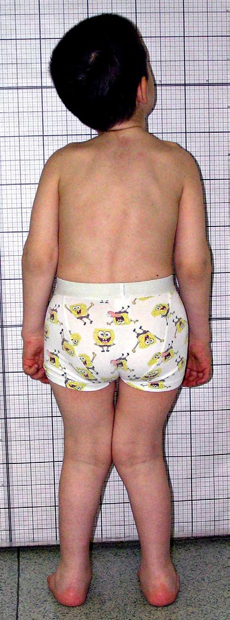 5 cm (below 3 rd P, -3.5 SD), weight 21.5 kg (- 1.0 SD).
