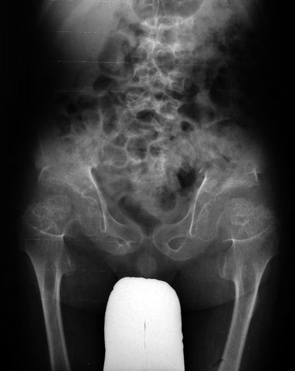 Fig. 5 A. MD variant. X-rays, at age 7 years.