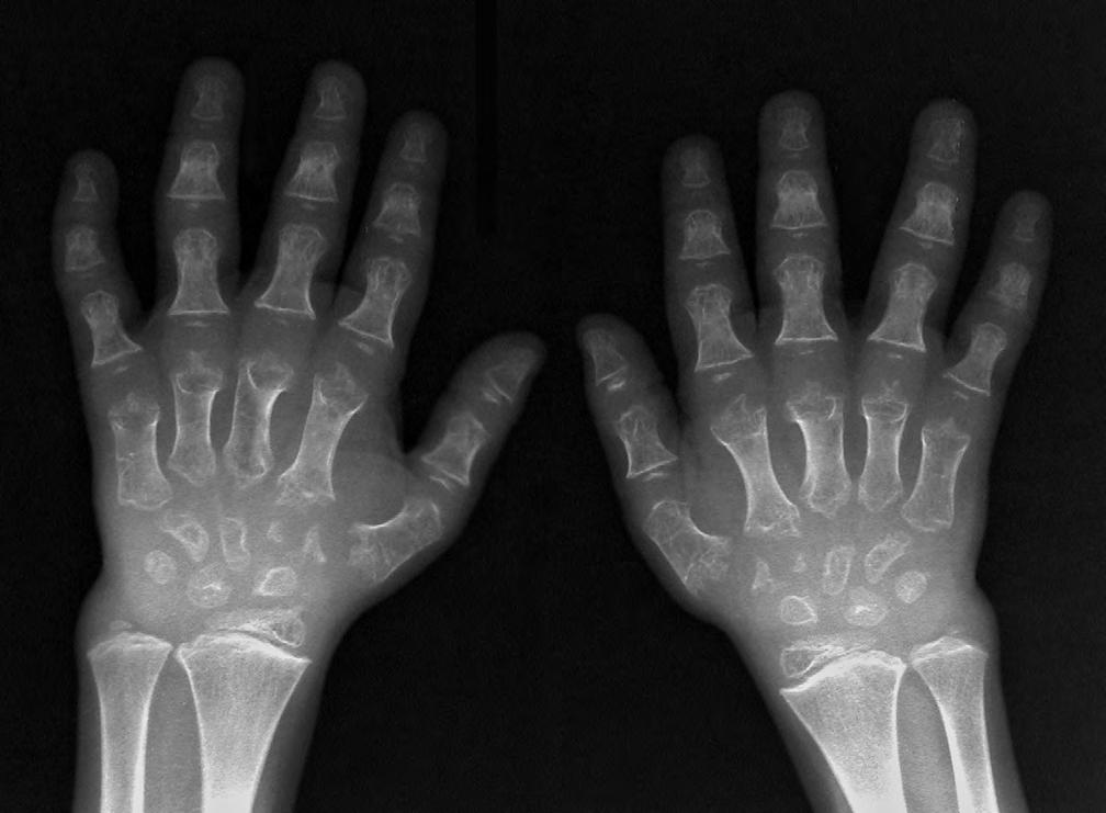 Fig. 5 B. MD variant. X-rays, at age 7 years. Short metacarpals and phalanges with flared ends. Hypoplastic/dysplastic carpal bones.