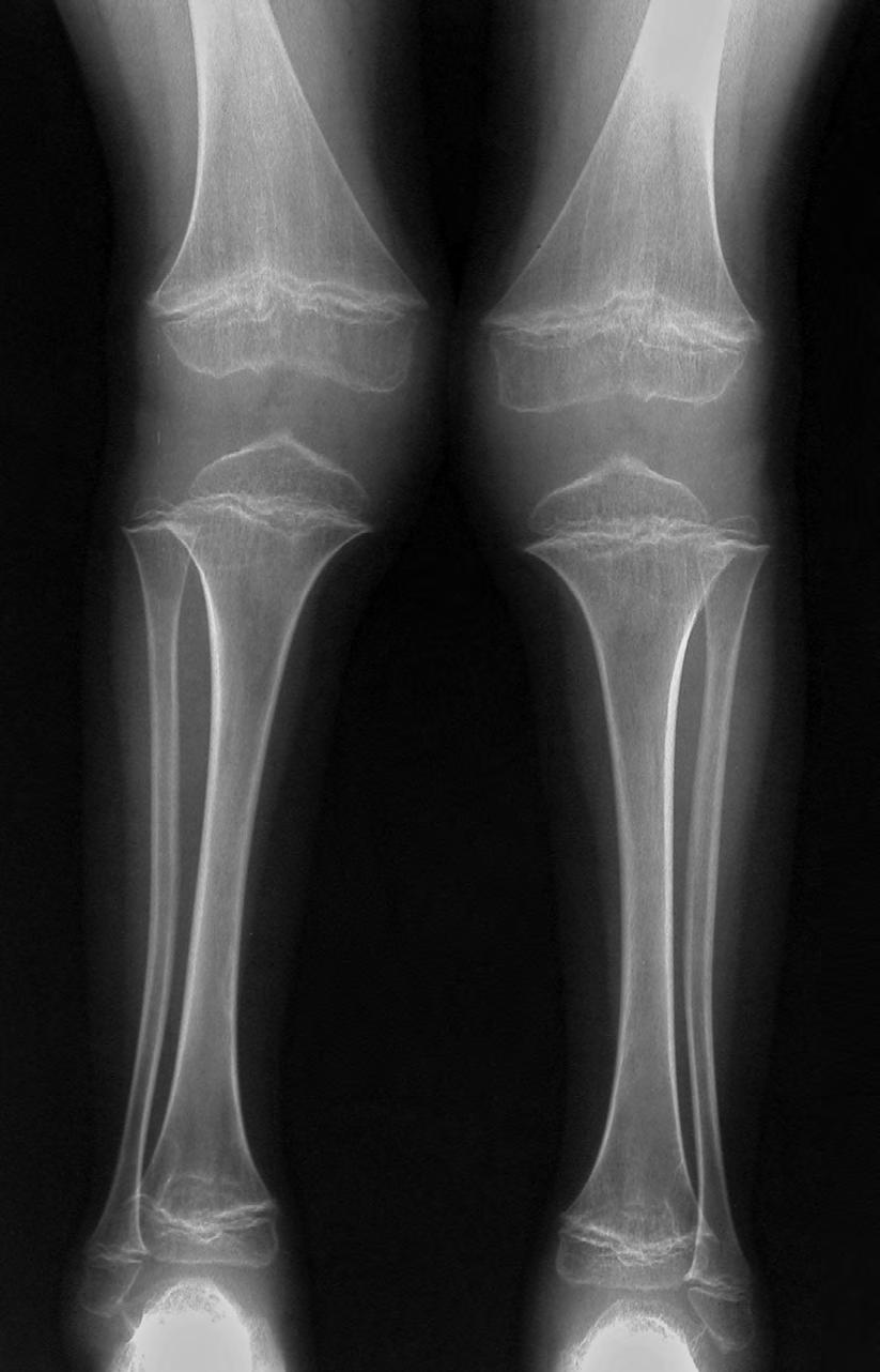 Fig. 5 C. MD variant. X-rays, at age 7 years.