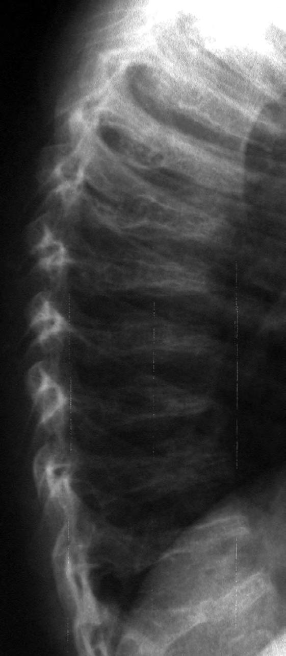 Fig. 5 F. MD variant. X-rays, at age 7 years.