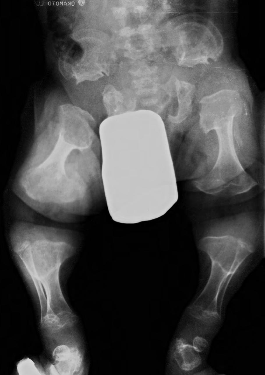 Fig. 6 A. X-rays of lethal variant of MD.