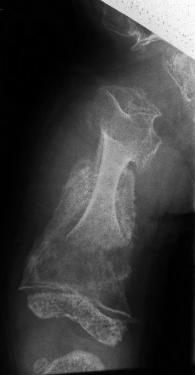 Fig. 6 B. X-rays of lethal variant of MD.