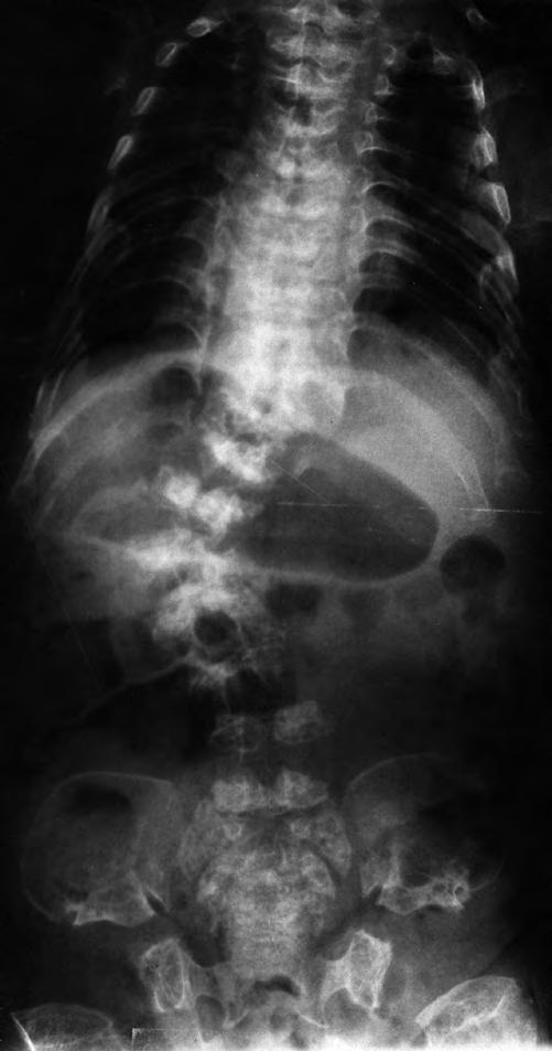 Fig. 6 C, D. X-rays of lethal variant of MD. Progressive kyphoscoliosis and small narrow thorax at age 8 months (C) and 6 years (D).