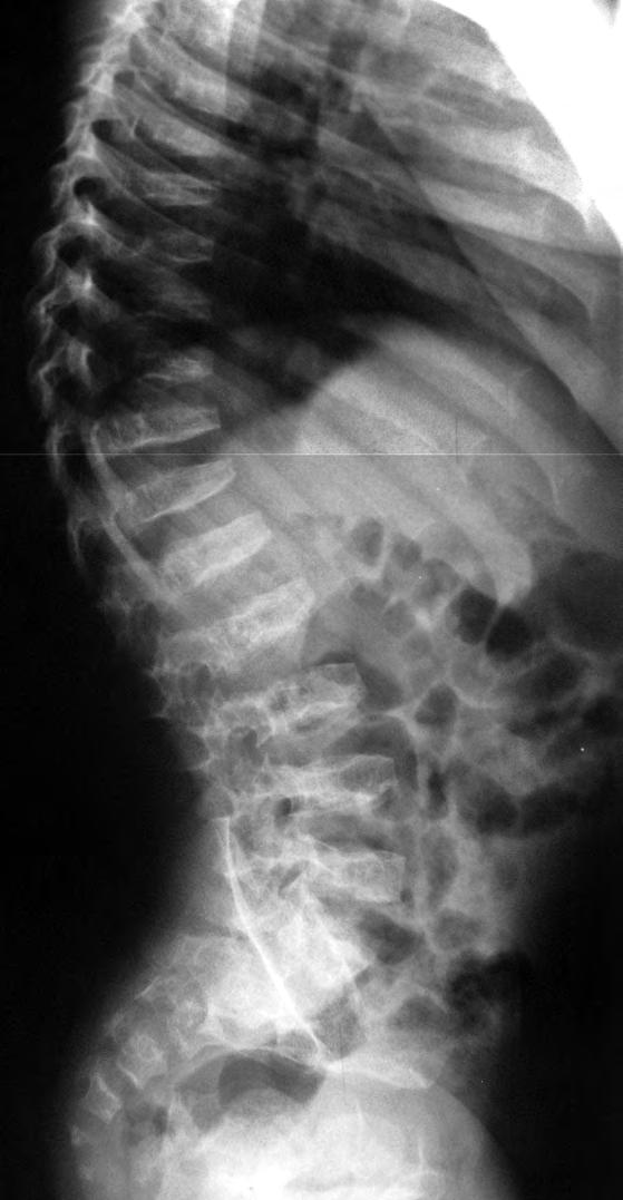spondylometaphyseal dysplasia.
