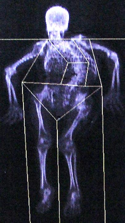 Fig. 8 A, B. Whole-body scans.