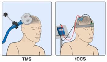 Typy neinvazivní mozkové stimulace repetitivní transkraniální magnetická stimulace (rtms- repetitive