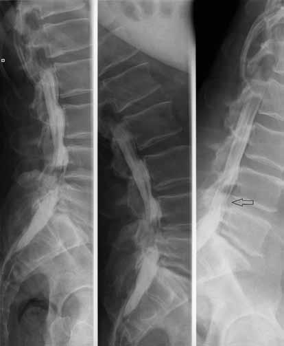 Zobrazovací metody 39 Obr. 4.2B. Myelografie, stenóza páteřního kanálu na podkladě herniace disku L4/L5, osteochondróza disku L5/S1.