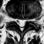 struktur utvářejících tři základní skloubení meziobratlový disk se sousedními obratlovými těly a dva malé intervertebrální (facetové, zygapofyseální) klouby.