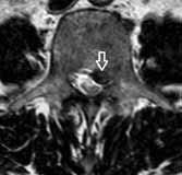 epidurálním prostoru (obr. 4.12.). Vzácně může dojít až k natržení míšních obalů a fragment proniká do durálního vaku intradurální herniace disku.