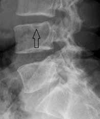 Intraspongiózní herniace jsou častým nálezem a jsou většinou asymptomatické, mnohočetný výskyt je u Scheuermannovy nemoci.