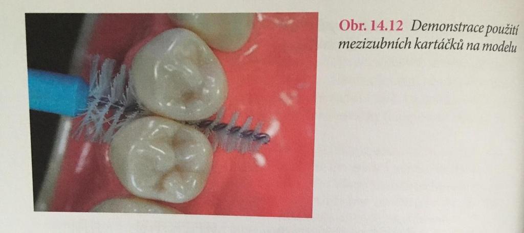 Obrázek 3 Použití mezizubního kartáčku