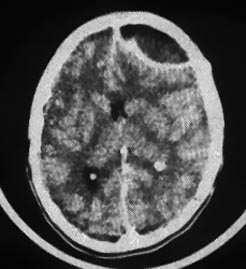 3.5.2 Infekce CNS bakteriální etiologie 3.5.2.1 Pneumokokové meningitidy Meningitidy vyvolané Streptococcus pneumoniae patří v současné době k nejvýznamnějším původcům mortality a morbidity na celém světě.