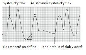 Chyby timingu - vyfouknutí Předčasné vyfouknutí prohloubení poklesu tlaku před pozdní diastolou Augmentace