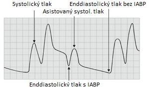 s exacerbací ischémie. Vzrůstá spotřeba kyslíku v myokardu.