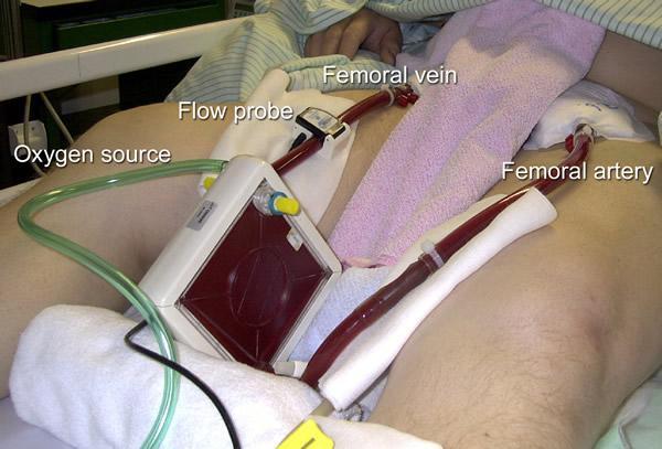 ECLS ECLS Extracorporeal Lung Support Bez použití krevní pumpy - pecls A-V systémy průtok je