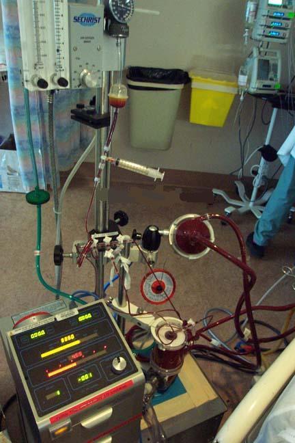 Hlavní součásti: Konzole, průtokové čidlo Centrifugální pumpa Oxygenátor Průtokoměr, směšovač Hadice Kanyly Systém pro ECMO životnost oxygenátoru 14 dní