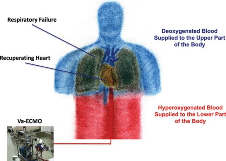 Komplikace dané neadekvátní funkcí ECMO Recirkulace (VV ECMO) Dilatace levé komory