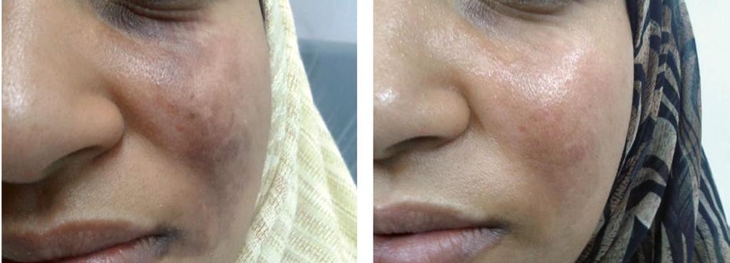 10 Oxynergy Paris Group PREPARÁTY NA OBLIČEJ Monopreparáty F-VITAMIN A Retinol palmitát 10% prevence změn souvisejících s věkem akné (post-akné) neutralizace volných radikálů stimulace syntézy