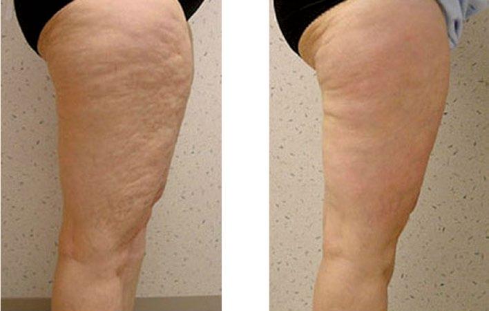 Oxynergy Paris Group 13 F-SILORG Struktura koktejlu: normalizace lipolytické aktivity, korekce strií, edému, alopecie, kombinovaná léčba fotostárnutí UPOZORNĚNÍ: preparát se aplikuje i na obličeji