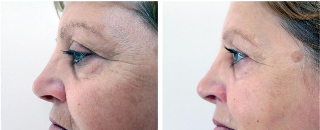 Oxynergy Paris Group 17 NOVINKA F-ANTI-OX Vyvážený koktejl «Antioxidant» pro účinnou antioxidační ochranu buněk, aktivní obnovu, lepší zářivost a tón pleti, snížení pigmentace v důsledku snížení