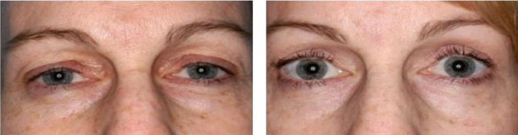 Oxynergy Paris Group 9 F-SILORG Struktura koktejlu: normalizace lipolytické aktivity, korekce strií, edému, alopecie, kombinovaná léčba fotostárnutí Organický křemík 5% tuk (zásoba, ukládání) strie