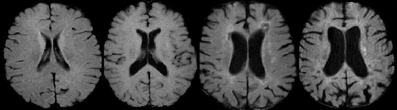 5 Disease duration: 5 years EDSS score 4.