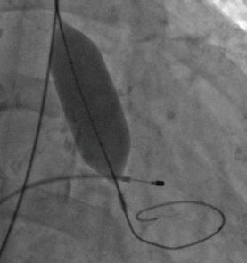 Aortální valvuloplastika Součástí výkonu TAVI Bridge k SAVR nebo TAVI - u hemodynamicky nestabilních pacientů - u symptomatických pacientů s těžkou AS před urgentní nekardiální operací (ESC IIb/C)