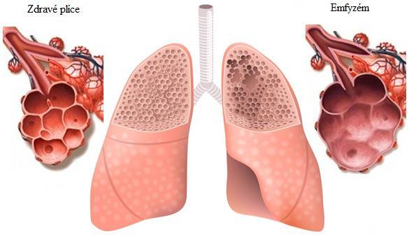 Obr. 3.3 Srovnání plic a plicních sklípků zdravého člověka a člověka s emfyzémem plic (převzato z: (38), upraveno) Poškození plic způsobené plicním emfyzémem je nevratné.