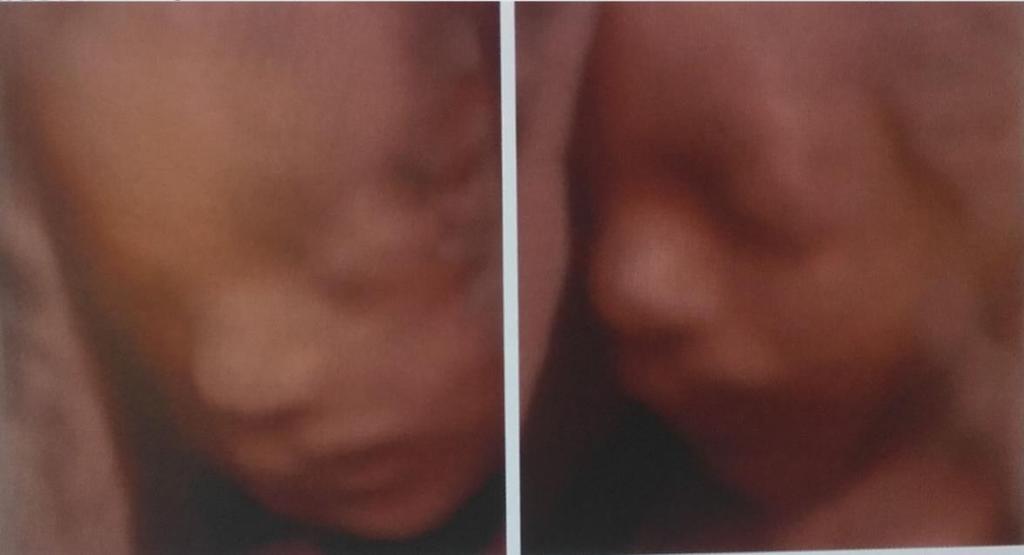 vada, velmi závisí na zkušenostech odborníka, na kvalitě přístrojového vybavení a na typu provedených vyšetření. Rozštěpy patra se diagnostikují hůře než rozštěpy rtu.
