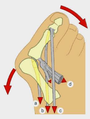 Obrázek 4: MTP kloub palce v přítomnosti HV (a: m. abductor hallucis; b: m. flexor hallucis longus; c: m. extensor hallucis longus; d: m. adductor hallucis) Zdroj: http://www.hirslanden- bibliothek.