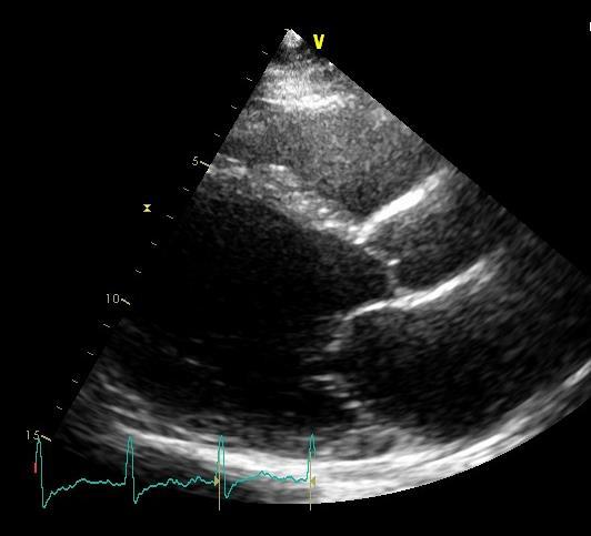 Obrázek 2. ECHO srdce u nemocného s myokarditidou - dilatace a remodelace LK 2.6.