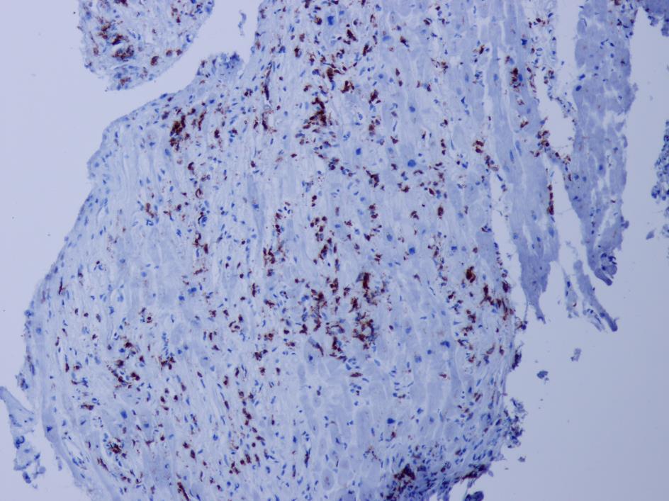 Fulminantní myokarditida - detekce CD3+ buněk (T-lymfocytů),