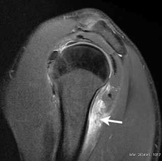 U tohoto pacienta jsme diagnostikovali úponovou posttraumatickou tendinopatii m. teres minor a parciálně i kaudální část m. infraspinatus (obr. 3).