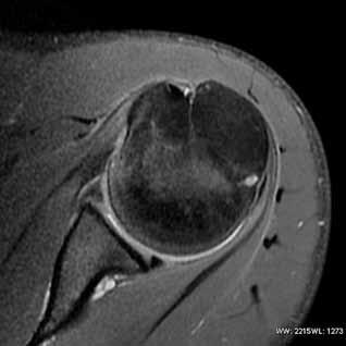 Také v tomto případě nešlo o obraz PSI, ale o skeletální trauma lemu glenoidální jamky. 3a 3b 3c 3d 3e Obrázek 3a-e.