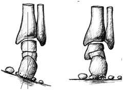 Obr. 1. Převzato ze Speciální kineziologie (Dylevský 2009) TYPOLOGIE NOHY DLE ROOTA: Na bázi biomechaniky a kineziologie rozdělil Root nohu na 4 typy, a to dle postavení přednoží a zánoží.