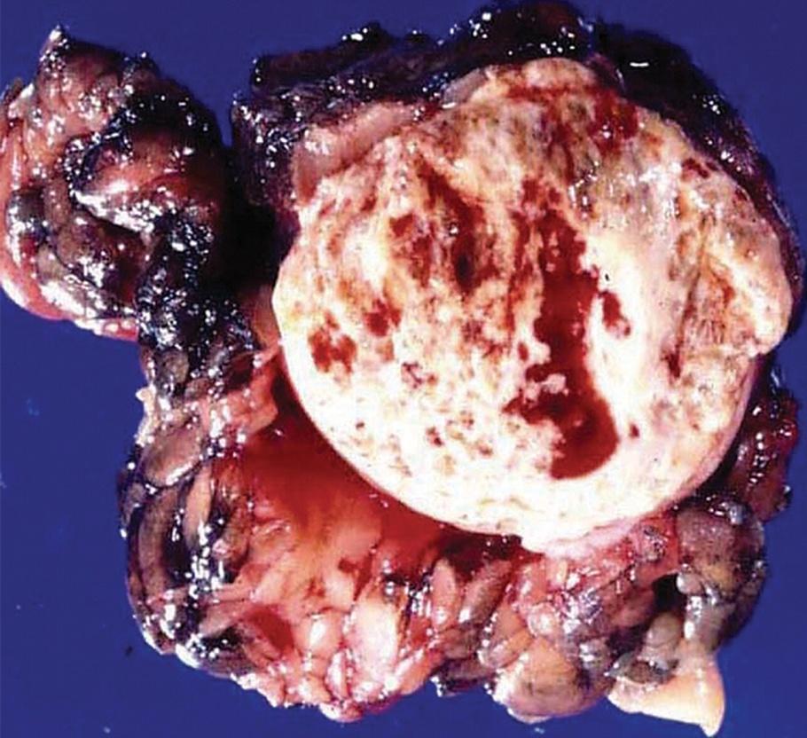 Obrázek 3. Papilární renální karcinom.