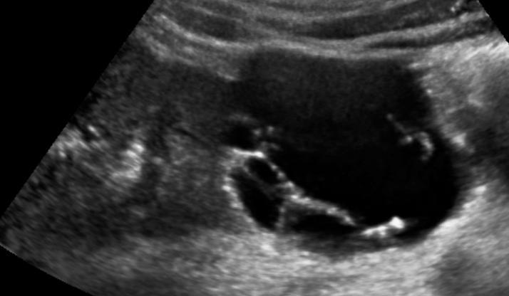 zobrazení dopplerovského průtoku nebo energie. Ultrasonografie dokáže velmi detailně zobrazit septa a je také citlivější v detekci sept než CT (Obrázek 4).