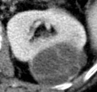 Obrázek 5. CT v nefrografické fázi. Cystické ložisko se sytícími se septy kategorie Bosniak III. Histologicky multilokulární cystický karcinom.