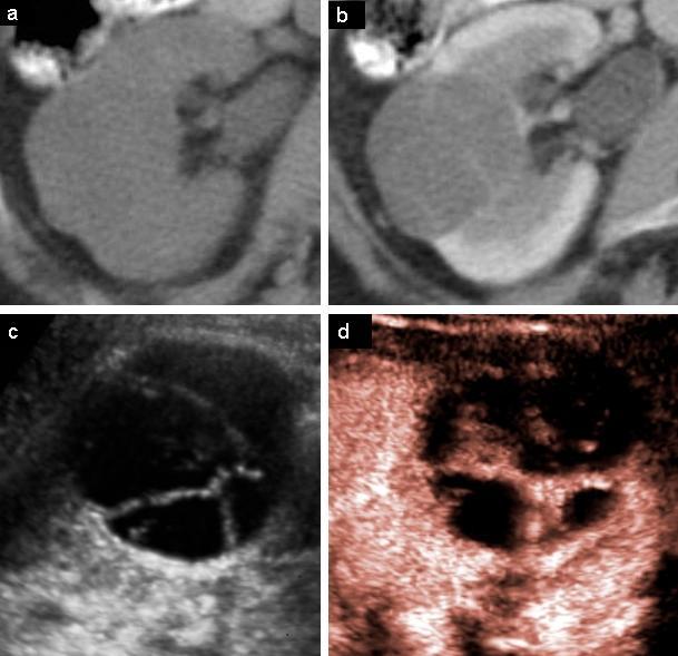 Srovnání obrazových charakteristik na CT a CEUS u dvou z histologicky ověřených ložisek uvádí Obrázek 7 a Obrázek 8. Obrázek 7. Srovnání CT a CEUS. a. Nativní CT.