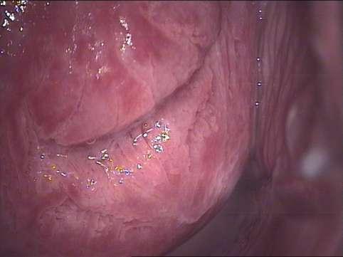 22: Invazivní adenokarcinom hrdla děložního Kolposkopicky suspektní invaze již s