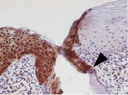 Obrázek 36: Imunohistochemický průkaz p16 v CIN III.