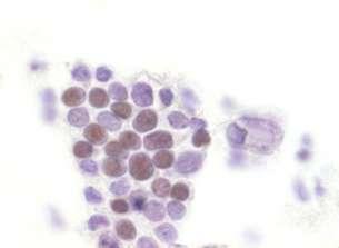 Obrázek 54: p16 pozitivní buňky endometria bez dysplázie.