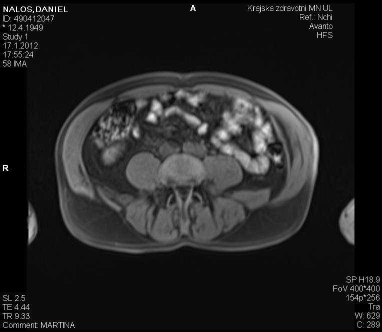 TAP block MRI