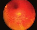 V âeské republice jsou zatím s tûmito léãivy v oftalmologii malé zku enosti [4,10,12,14].