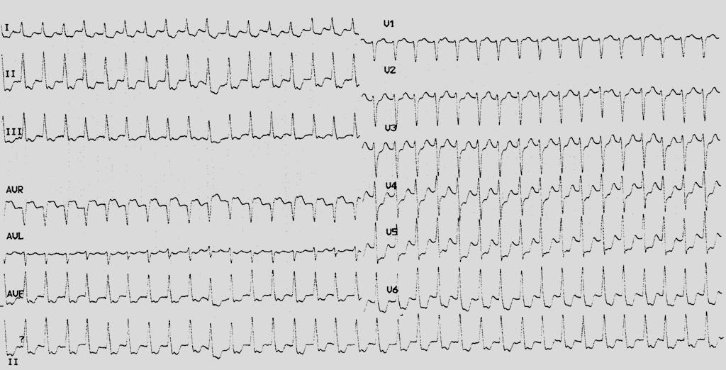 EKG 1