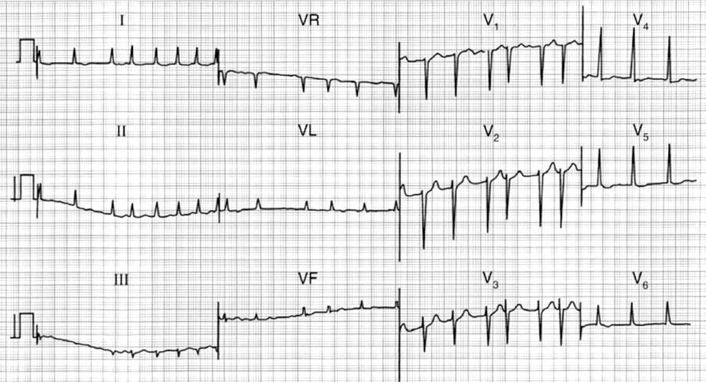 EKG 4