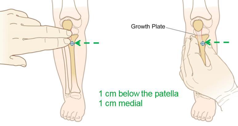 patelu + 1 cm mediálně