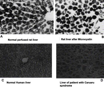 Caruaru syndrom 1996 Brazílie Normal human liver
