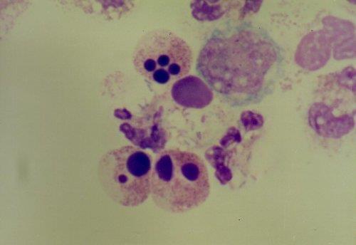 Obrázek 8: Degenerativní formy neutrofilů 14. PATOLOGICKÉ CYTOLOGICKÉ NÁLEZY V LIKVORU Známky nespecifické aktivace v cytologickém obraze: Příčiny např.